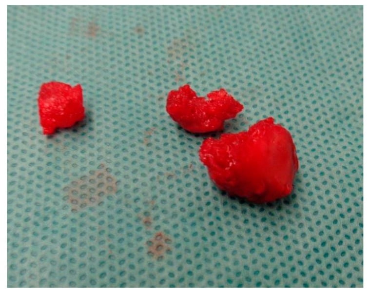 Operative specimen showing a comminuted pisiform removed in three fragments.