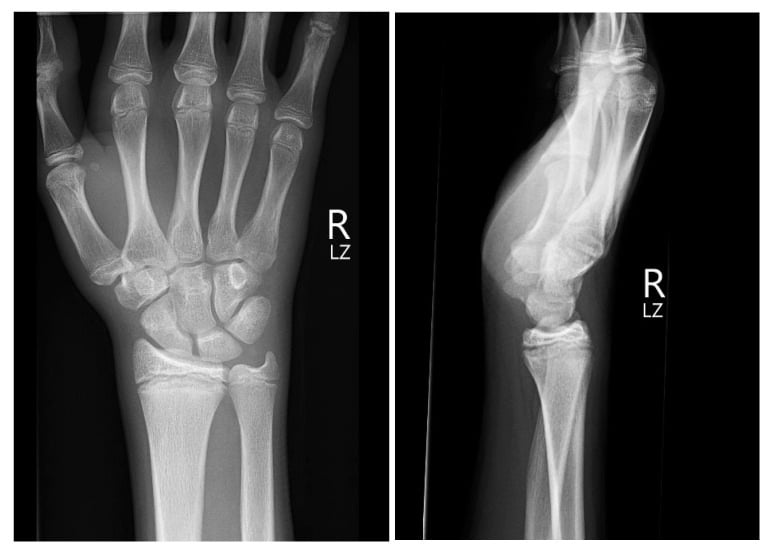 Initial AP and lateral wrist radiographs before CT confirmation of a non-displaced pisiform fracture.