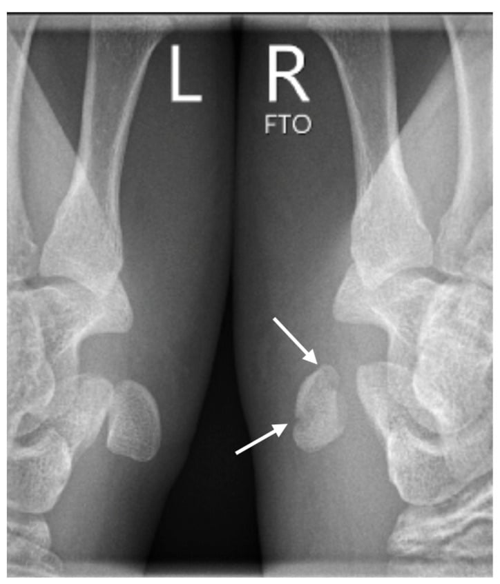 Side-by-side 30-degree semisupination oblique wrist radiographs showing a non-displaced pisiform fracture on the injured side.