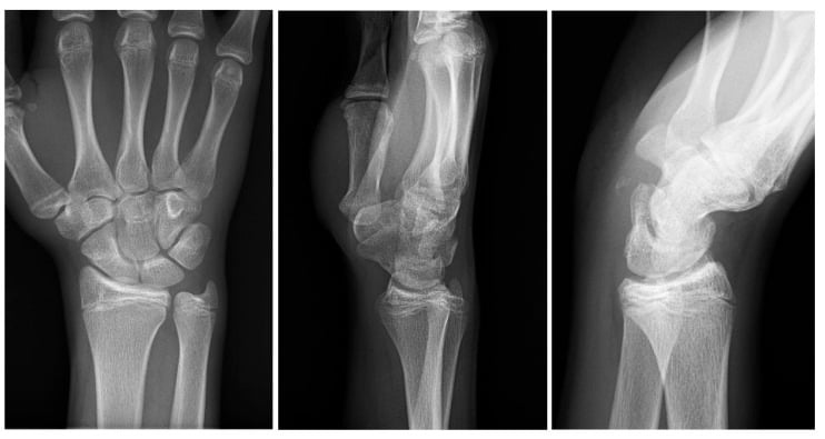 Postoperative AP, lateral and semisupination wrist radiographs after pisiform excision showing small residual fragments.
