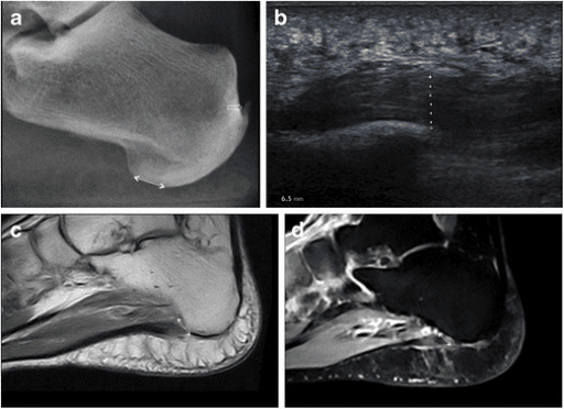 Multimodal imaging of plantar fasciitis - X-ray, ultrasound, and MRI comparison