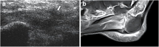 Plantar fascia rupture on ultrasound and MRI