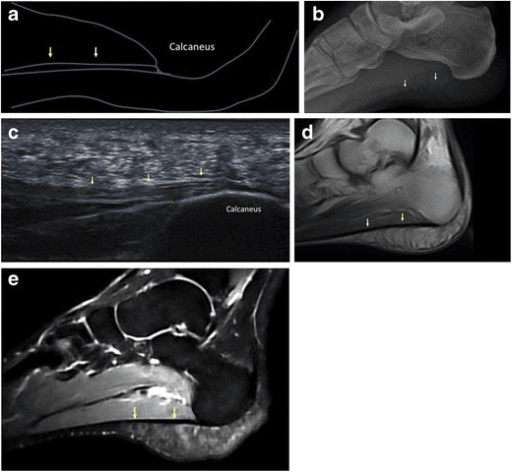 Normal plantar fascia appearance on multimodal imaging