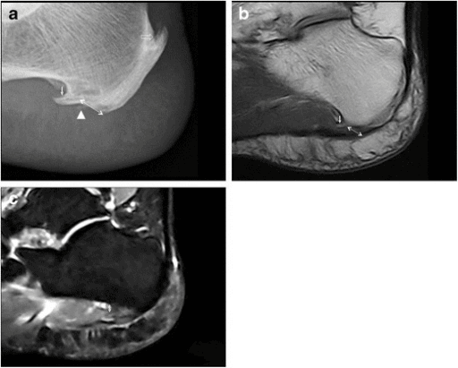 Classic plantar fasciitis imaging findings