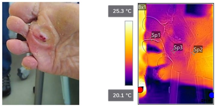 Clinical and thermographic images of a plantar callus showing lower surface temperature than adjacent skin