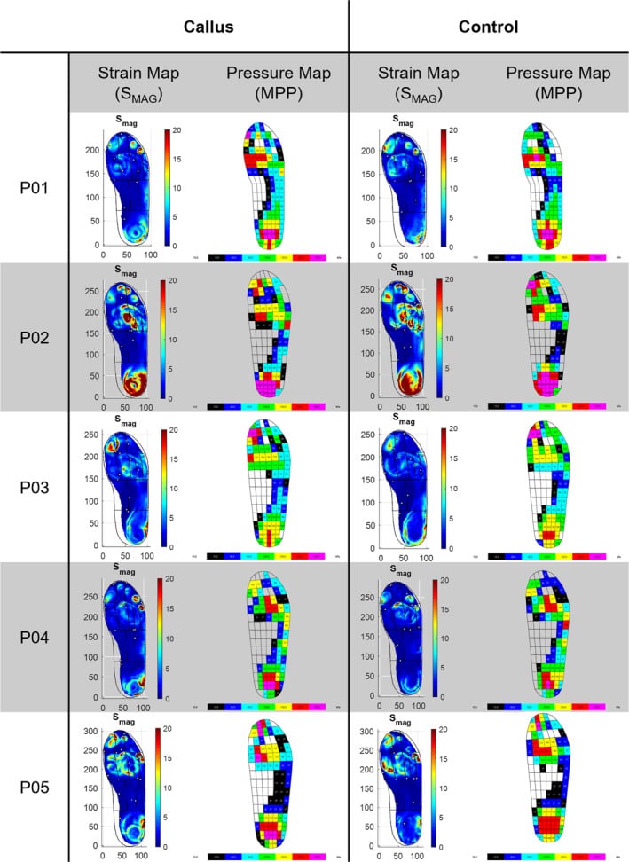 Paired plantar strain and pressure maps comparing callus and control conditions across five feet