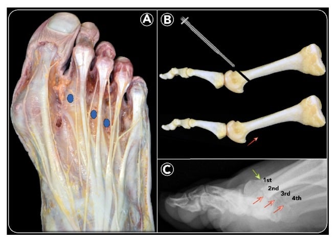 Dorsal foot anatomy and radiographs showing distal metatarsal metaphyseal osteotomy incision sites and metatarsal-head elevation
