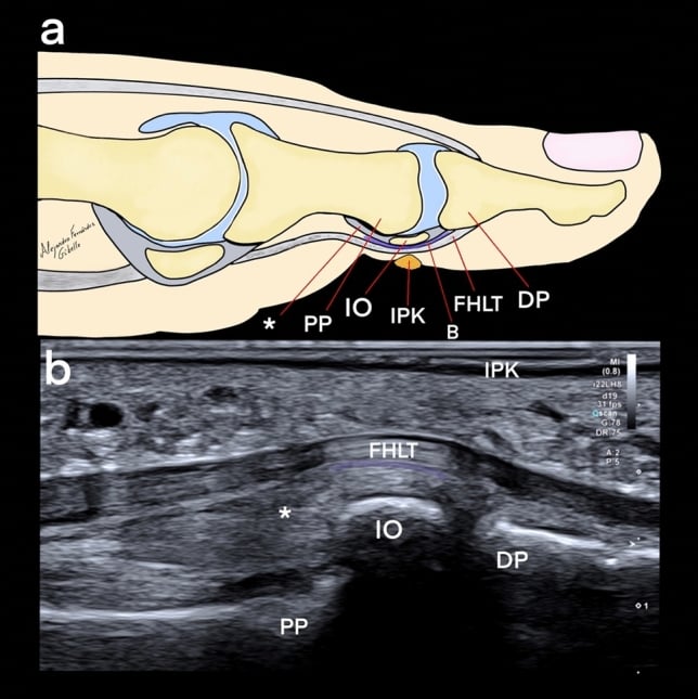 Sagittal ultrasound and anatomical diagram of hallux plantar keratosis over an interphalangeal ossicle and bursa