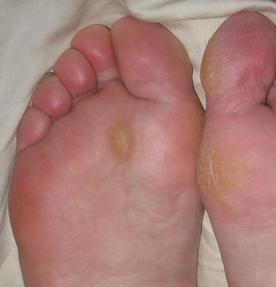 Clinical photograph of the soles of both feet showing plantar calluses including a discrete keratosis under the forefoot