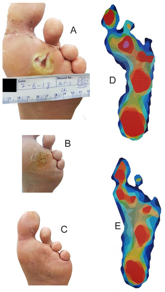 Clinical photographs of a callus-surrounded submetatarsal ulcer and pedobarographs before and after floating metatarsal osteotomy