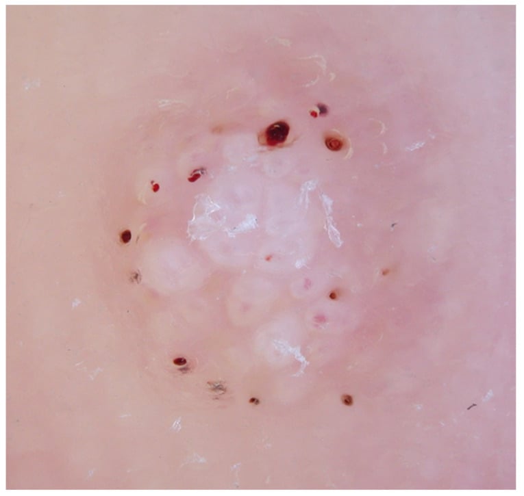 Dermoscopy of a pared plantar wart showing frogspawn-like white halos and central capillary dots