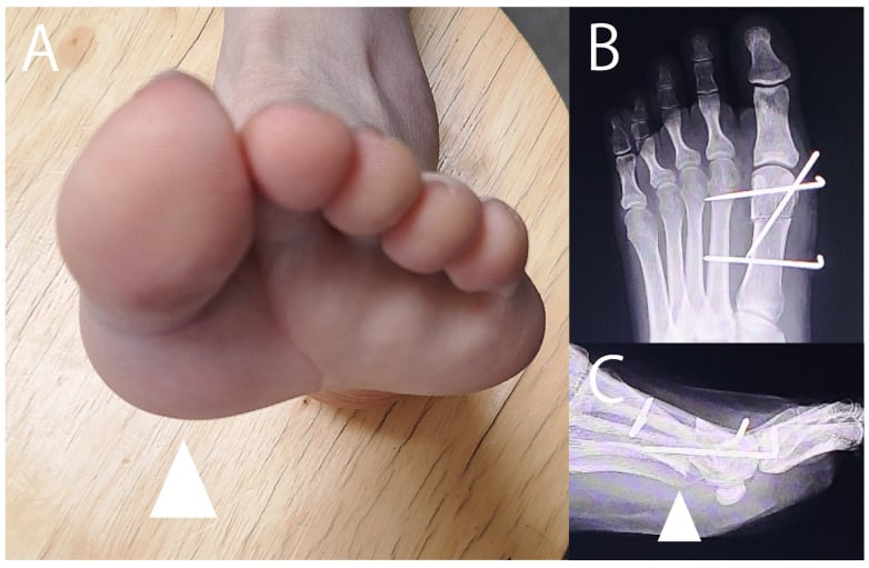 Plantar sesamoid keratosis with radiographs showing proximal and dorsal metatarsal-head sliding osteotomy