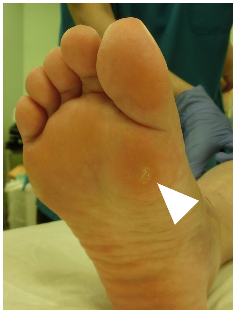 Clinical plantar view showing a focal keratosis directly beneath the tibial sesamoid
