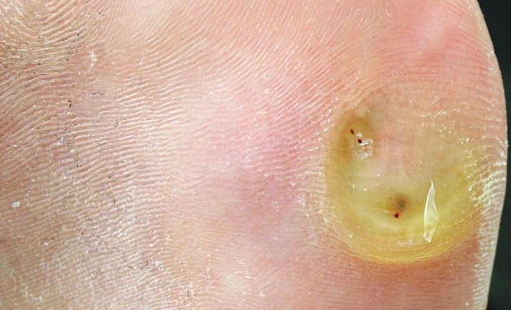 Close-up photograph of a plantar wart showing interrupted skin lines around a yellowish keratotic lesion with visible pinpoint dark dots from thrombosed capillaries