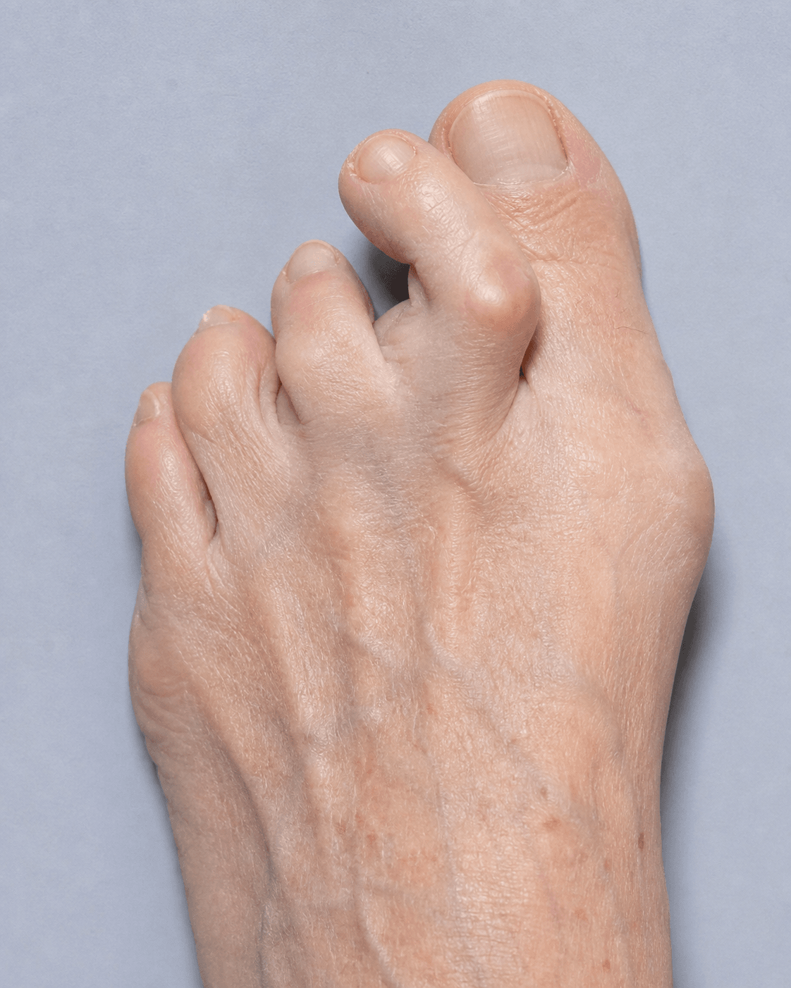 Clinical photograph of a forefoot showing the second toe deviated medially and dorsally over the great toe (crossover toe).