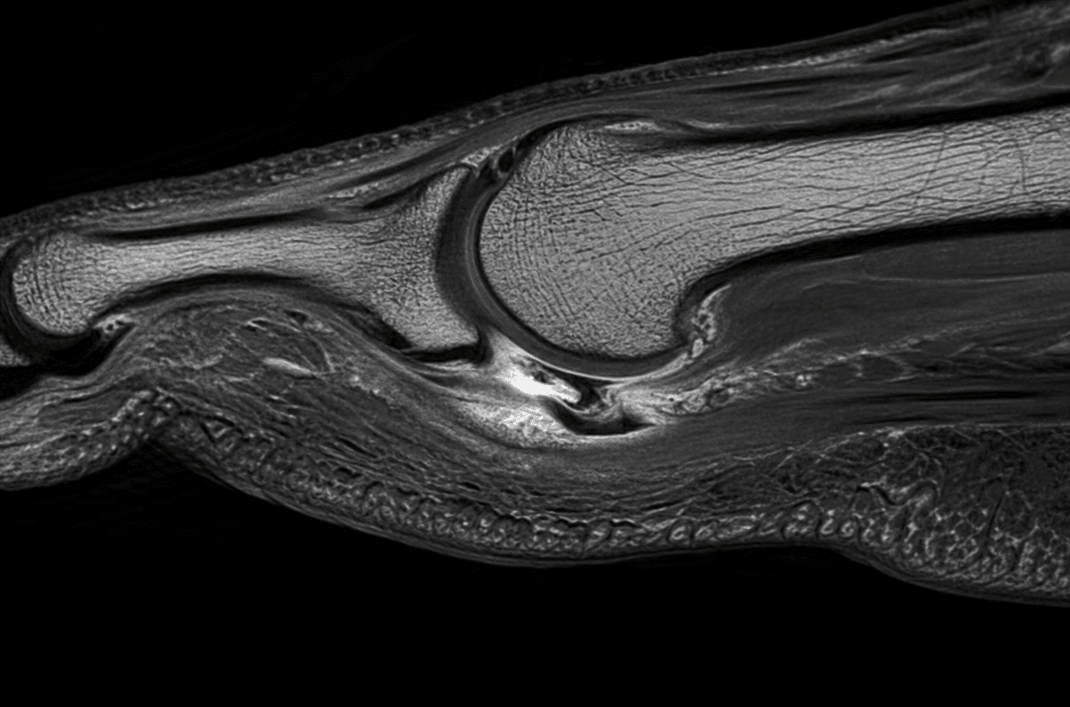 Sagittal MRI of the second metatarsophalangeal joint showing high signal at the plantar plate insertion consistent with a tear.