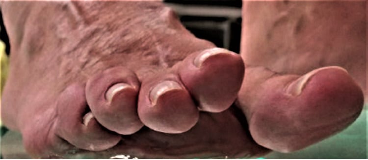 Plantar view showing postoperative floating lesser toes after Weil osteotomy