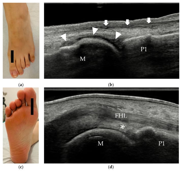 Probe positions and longitudinal ultrasound of a normal metatarsophalangeal plantar plate