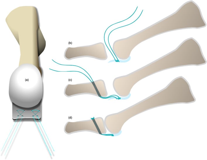 Schematic steps of dorsal-approach plantar plate repair using sutures and proximal-phalanx bone tunnels