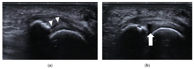 Dynamic ultrasound of a second MTP plantar plate tear before and during dorsiflexion stress
