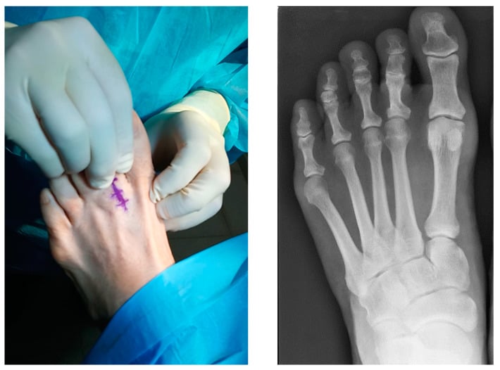 Clinical plantar drawer examination alongside a weight-bearing foot radiograph showing second MTP subluxation