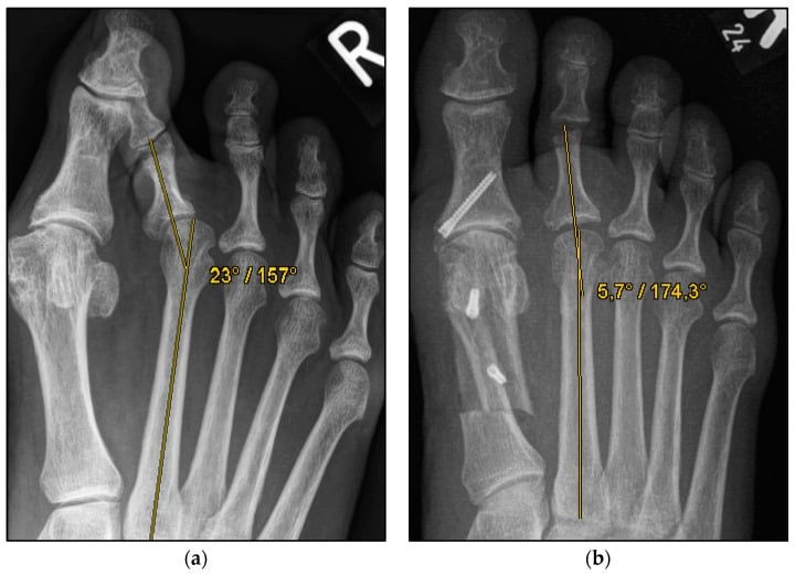 Preoperative and postoperative weight-bearing radiographs after second-metatarsal Weil osteotomy