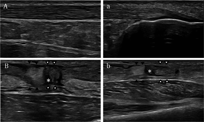 Dynamic ultrasound showing complete Achilles tendon rupture