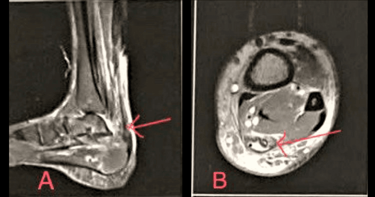 Sagittal and axial MRI showing Achilles tendon rupture