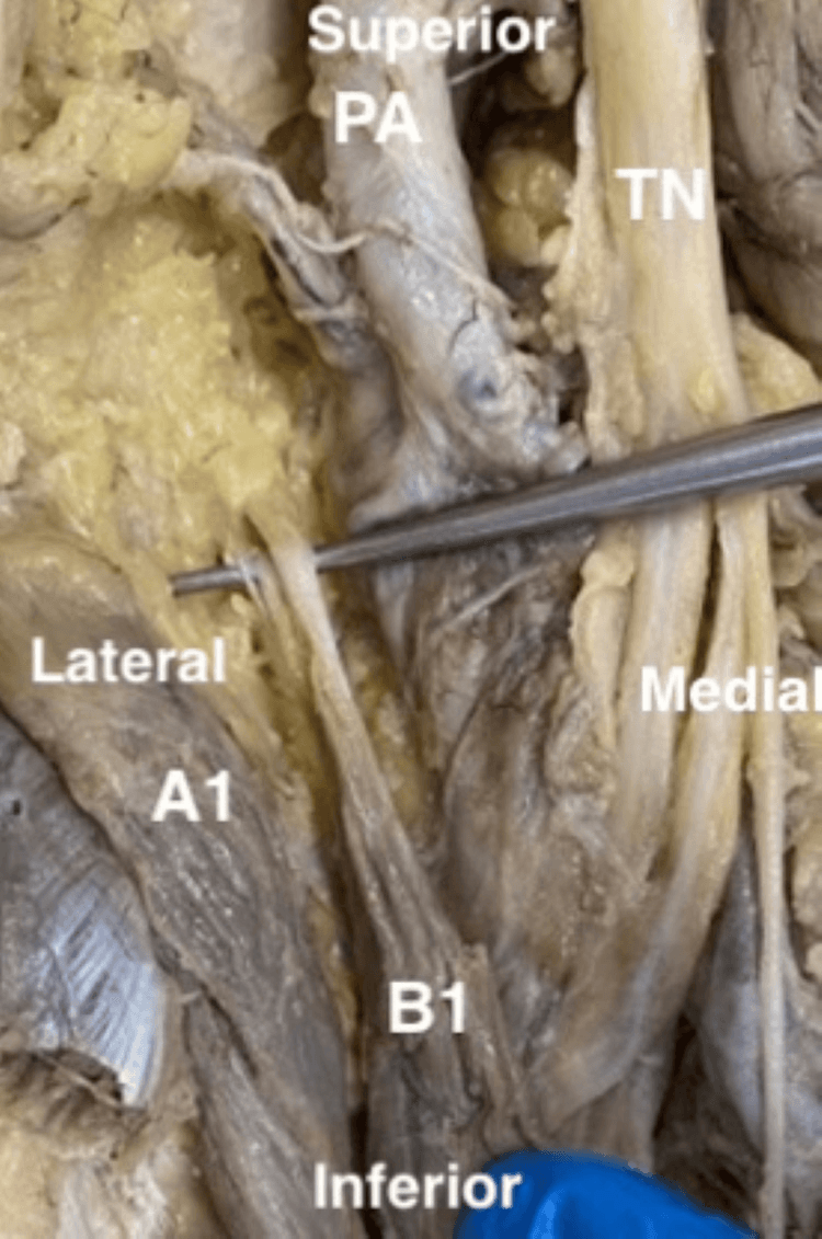 Cadaveric duplicated plantaris beside popliteal artery and tibial nerve