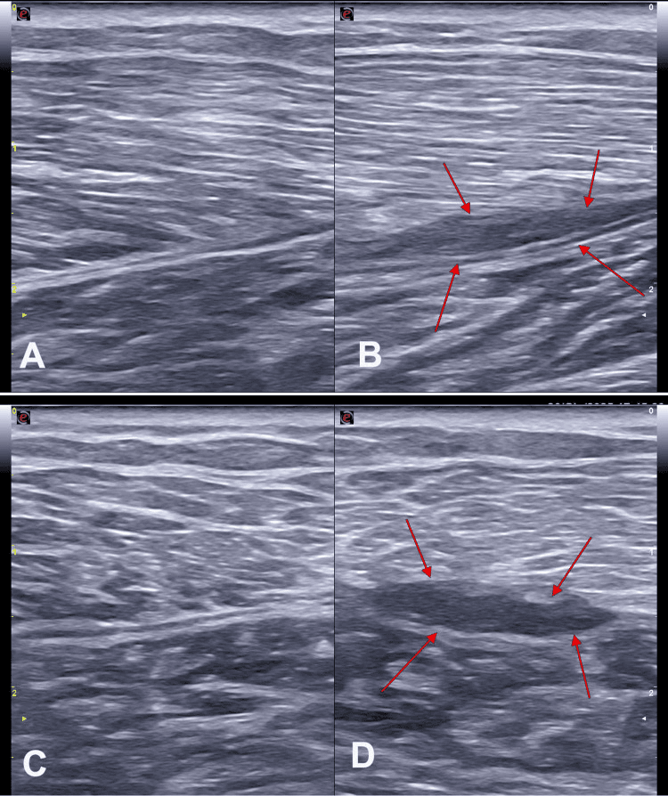 Ultrasound comparison of normal and strained medial gastrocnemius