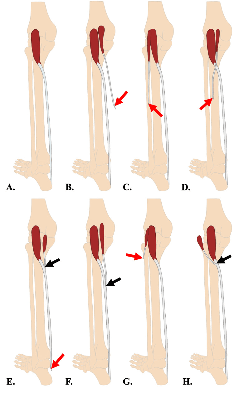 Accessory plantaris muscle origin and insertion variants