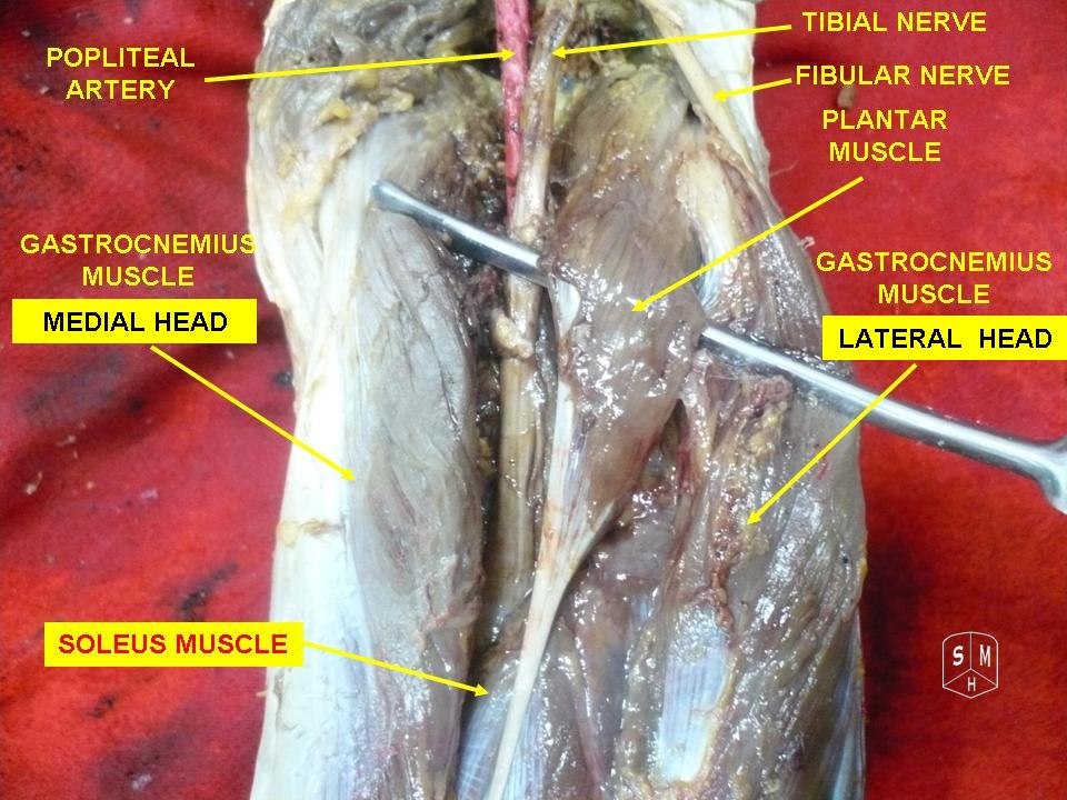 Cadaveric dissection of the posterior leg exposing the plantaris muscle belly and tendon.