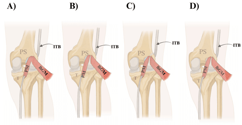 Plantaris insertion patterns and relations at the posterolateral knee