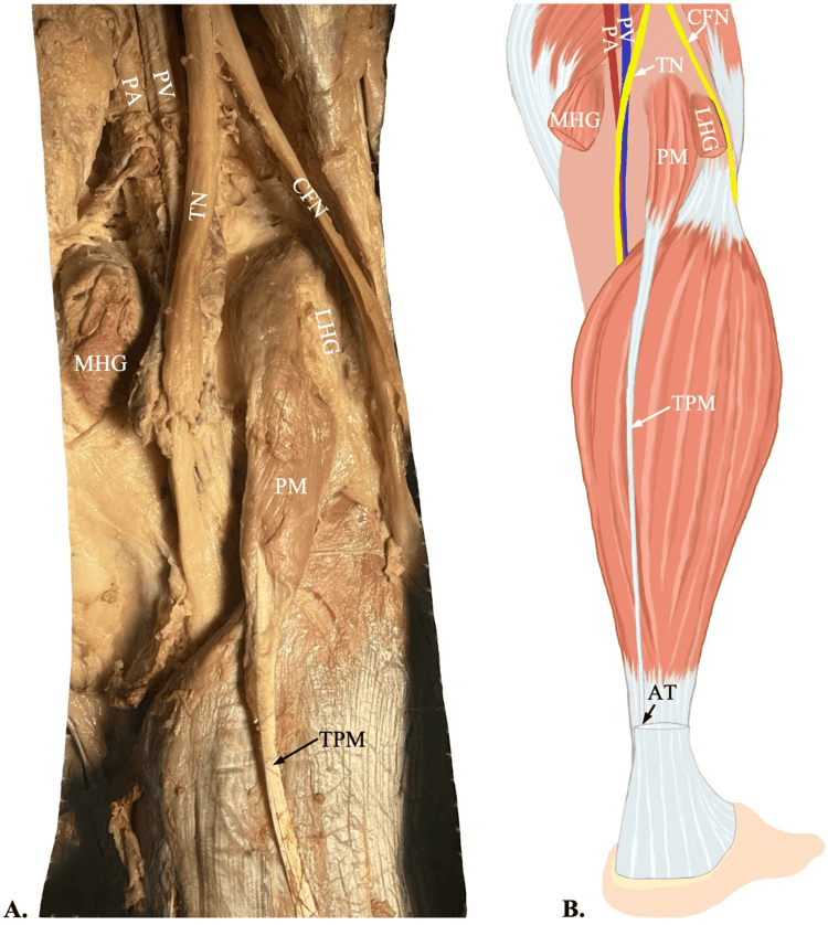 Cadaveric posterior-knee dissection showing plantaris origin and tendon