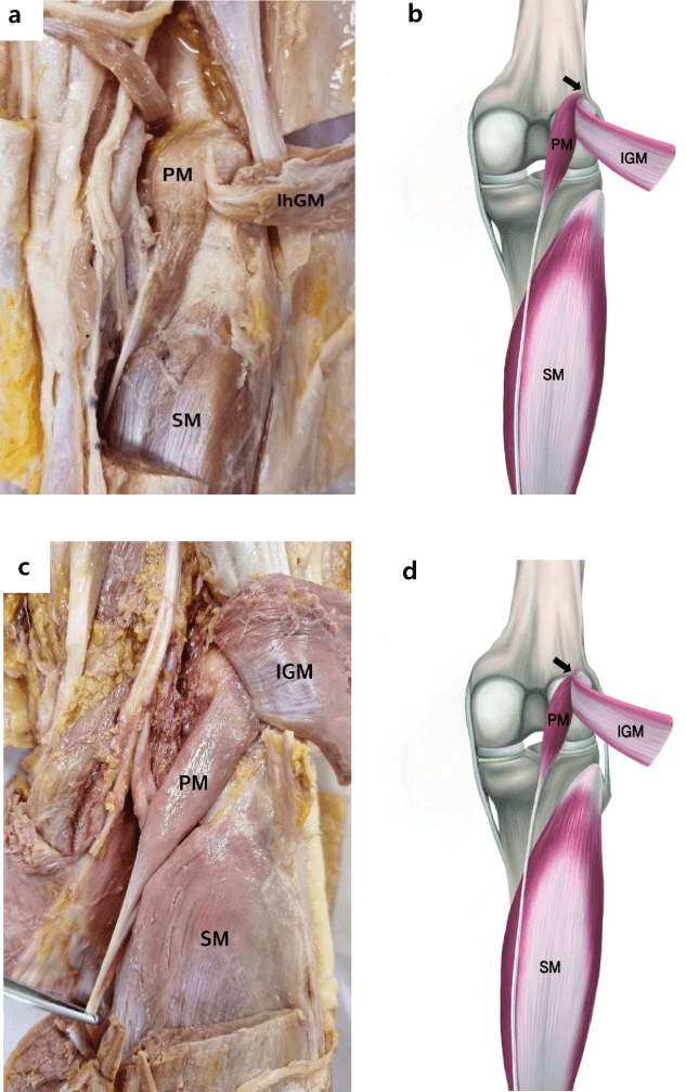 Cadaveric and schematic classification of plantaris origin types
