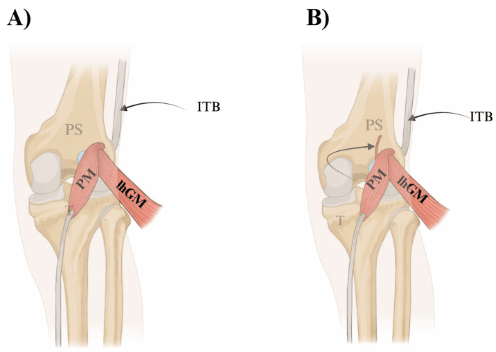 Plantaris origin variants from lateral femoral condyle capsule and gastrocnemius