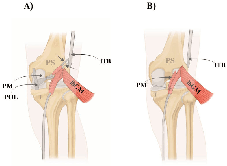 Rare heterogeneous plantaris attachment variants around the posterolateral knee