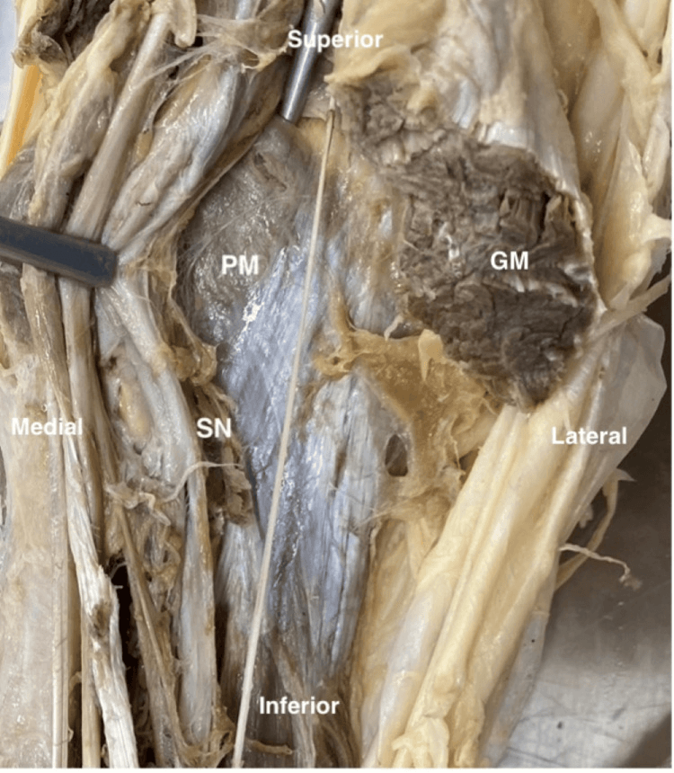 Cadaveric relation of plantaris to the sural nerve and gastrocnemius