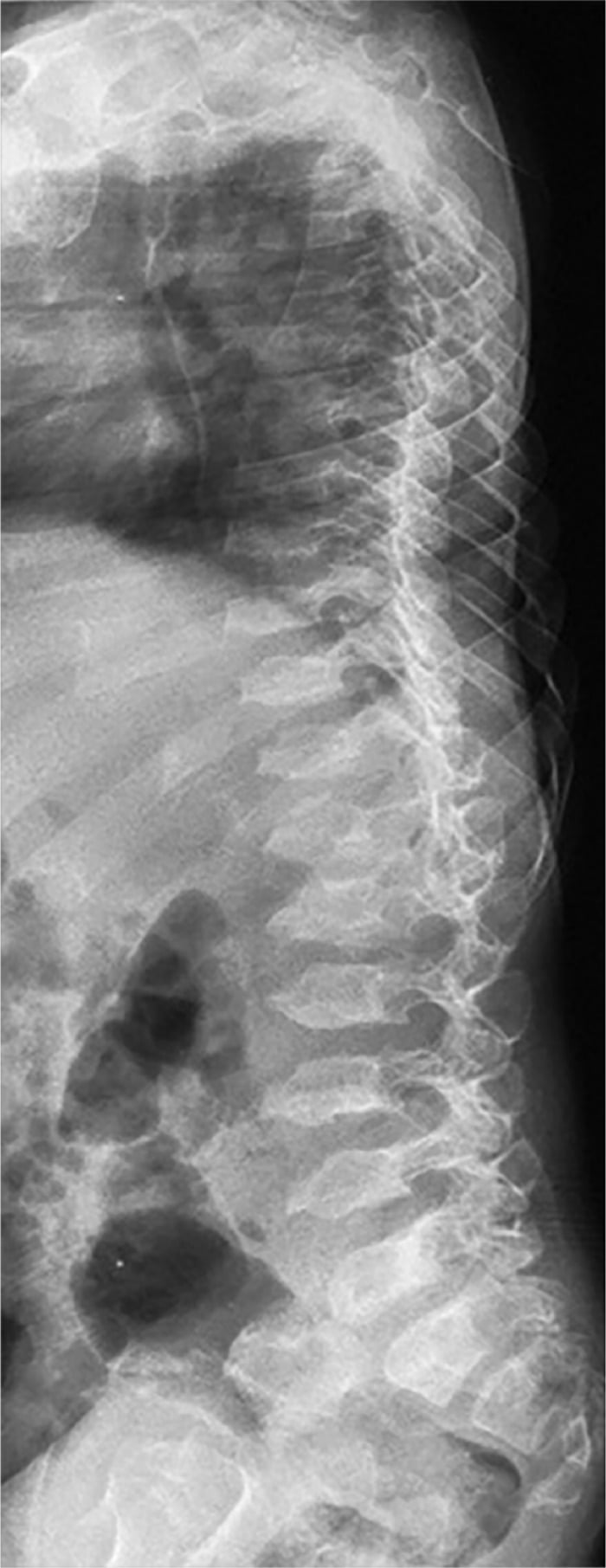 Lateral spine radiograph in a toddler with Morquio syndrome: oval, dorsally wedged vertebral bodies and platyspondyly.