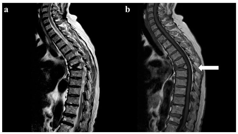 Sagittal T2 and T1 MRI of an acute osteoporotic T7 wedge fracture with band-like oedema and preserved posterior elements.