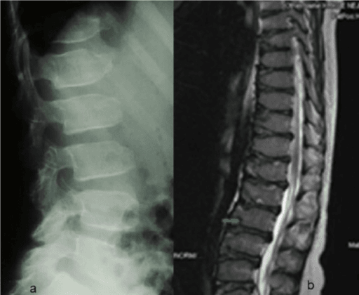 Lateral lumbar spine radiograph of a child showing poorly ossified anterior vertebral end-plates, most marked at L3.