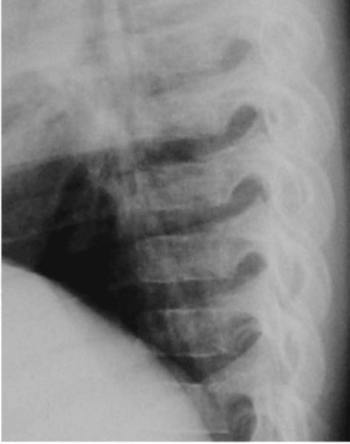 Lateral thoracic spine radiograph showing flattened vertebral bodies with widened disc spaces.