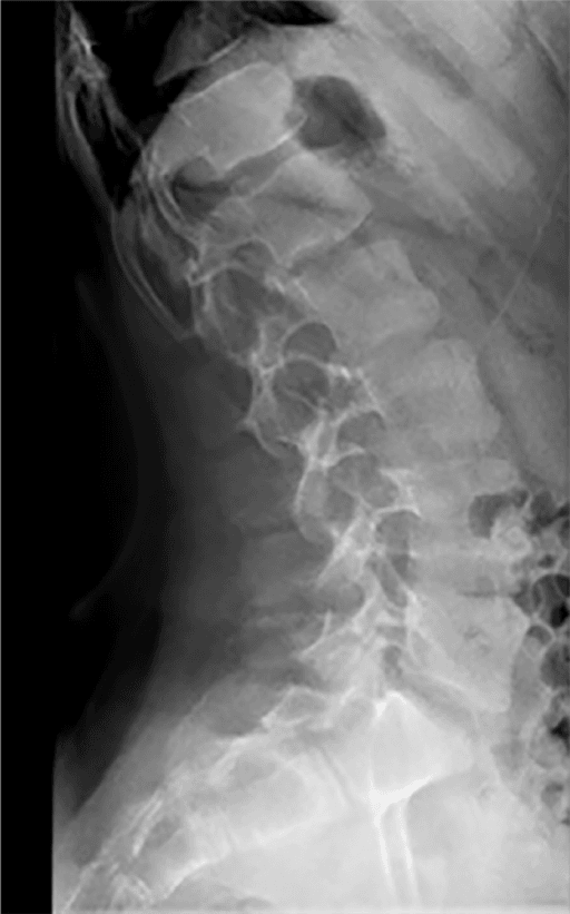 Lateral spine radiograph showing increased lumbar lordosis, mildly flattened T11 and T12 bodies and posterior vertebral scalloping.