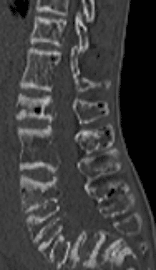 Sagittal three-dimensional CT reconstruction of thoracolumbar spine with flattened, fused and compressed vertebral bodies.