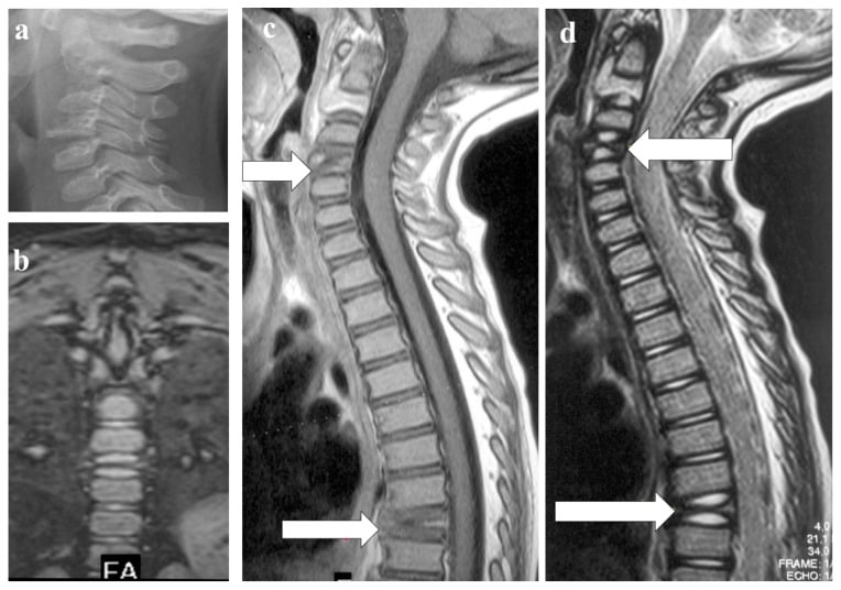 Lateral cervical radiograph and sagittal MRI showing C4 vertebra plana with marrow replacement in adult Langerhans cell histiocytosis.