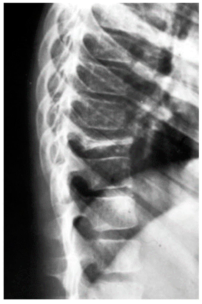 Lateral thoracic radiograph of a child with a single wafer-thin vertebra plana and preserved adjacent discs.