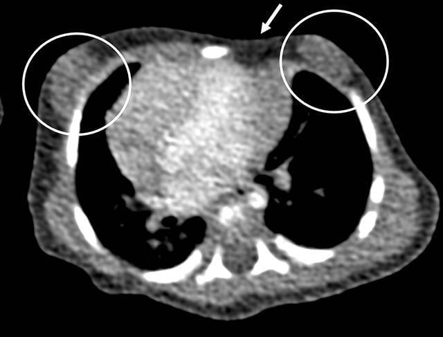 Axial mediastinal-window CT showing absence of the left sternocostal pectoralis major and depression of the anterior chest wall in Poland syndrome.