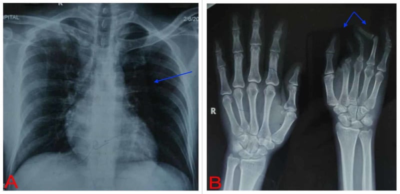 Paired chest and hand radiographs showing a hyperlucent hemithorax and ipsilateral brachysyndactyly in Poland syndrome.