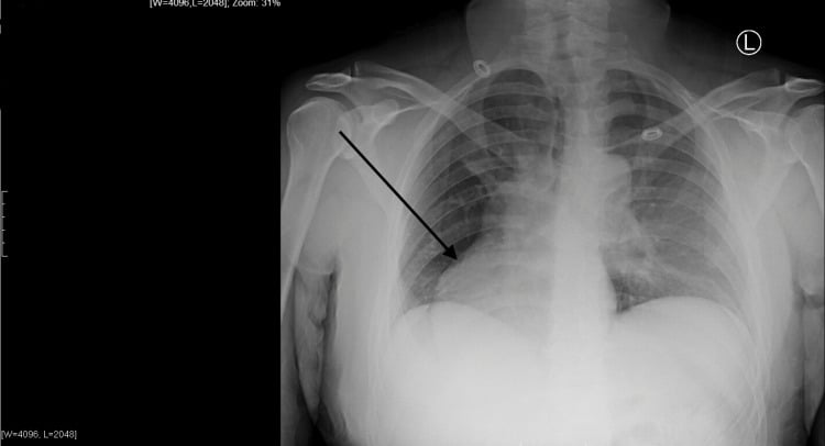 AP chest radiograph showing rightward cardiac position and chest-wall asymmetry in a patient with Poland syndrome.