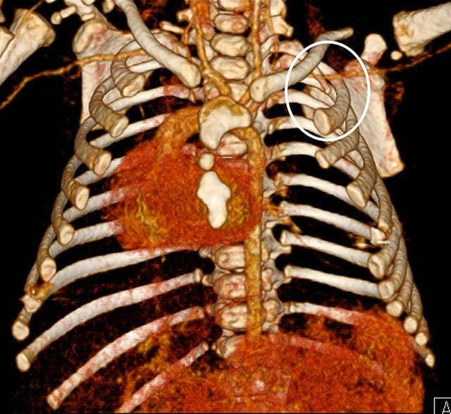 Anterior three-dimensional chest CT showing a dysplastic left hemisternum, hypoplastic first rib and rightward cardiac displacement in Poland syndrome.
